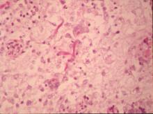 圖4：小腦軟化、格子細胞增殖、巨大細胞浸潤及分枝分節菌絲(PAS stain, 400X)。