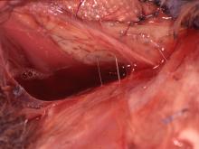 圖2：皮下大量滲出液，肌肉局部壞死。 