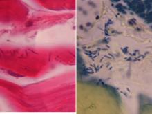 圖4A：高倍下可見到肌束細胞間有長桿菌存在。4B：以B&B染色後可見染色呈陽性的大量長桿菌存在於肌束與肌束間隙中。 
