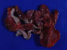 圖2：腹腔有大量乾酪物。