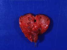 圖3：肺臟可見多發黃白色小節結。 