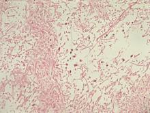 圖4：肺臟壞死區域內可見大量黴菌菌絲。 