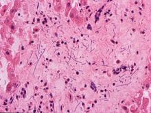 圖7：肝：肝囊狀隙擴張內充滿紅血球、肝索排列凌亂，近門脈區之肝細胞呈空泡化，可見少數短桿菌浸潤於竇狀隙中。