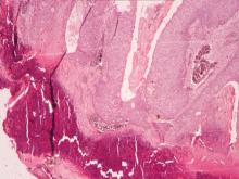 圖3：皮膚切片，上皮細胞增生空泡變性