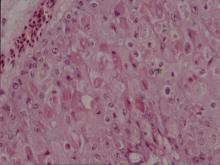 圖4：上圖高倍相，可見多數大小不一的嗜酸性質內包涵體。