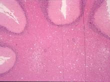 圖3：小腦：白質部呈現多發局部軟化。