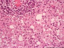 圖4：小腦：病灶區內神經膠質細胞增生，部份神經膠質細胞內可見嗜酸性核內包涵體。