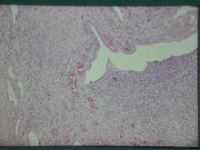 圖4：母犬，2歲，子宮蓄膿症，子宮內膜覆蓋上皮受損處，在上皮下層之間質組織有顯著的炎症反應。