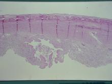 圖7：母犬，9歲，子宮蓄膿症，低倍鏡下，長期持續大量的子宮蓄膿使子宮肌層變薄，子宮內膜覆蓋上皮外受損消失，粘膜層呈現顯著炎症反應。