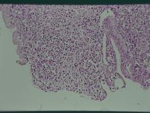 圖8：母犬，9歲，子宮蓄膿症，高倍鏡下可見到喪失上皮覆蓋的粘膜呈現顯著的炎症反應。 