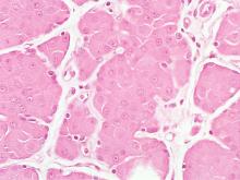 圖3：肛門右側腫塊組織可見一區一區的分葉狀類肝樣組織。腫瘤細胞呈多邊形，細胞核為圓形或卵圓形，核仁明顯。含有豐富呈粉紅色嗜酸性細胞質。在分葉周邊可見圓形或立方樣的儲備細胞(reserve cells)排列，數量不多且較呈嗜鹼性。(HE, 400X)