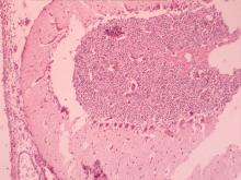 圖4：左側睪丸團塊組織切片可見長橢圓形或多角形細胞，細胞核小呈卵圓形或圓形，且呈高染色性，少見細胞有絲分裂相。細胞質內可見小空泡，另可見金黃色顆粒。(HE, 200X)