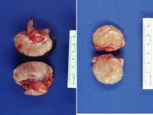 圖2A:陰囊腫塊切面為黃白色、局部出血灶、堅實的均質組織。2B:肛門右側腫塊切面為淡褐色之均質組織。