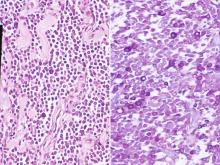 圖3A：腫瘤細胞呈片狀或索狀排列，其間可見膠原基質。腫瘤細胞核大且多呈圓形，核仁明顯，細胞質內可見細小顆粒。也可見到一些嗜酸球。(H & E Stain, 200X) 3B：腫瘤細胞質內出現異染性顆粒。(Toluidine blue, 400X) 