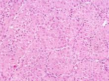 圖4:腫瘤細胞呈一區一區的分葉狀肝樣組織。腫瘤細胞含有豐富的嗜酸性細胞質。分葉周邊可見較嗜鹼性的儲備細胞(reserve cell)。(H & E Stain, 200X)