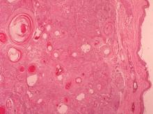 圖4：皮膚腫瘤團塊，位於真皮層及皮下組織間，由一層薄的結締組織包被，界限明顯，腫瘤區域有多發大小不一的角囊(horn cyst)。