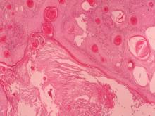 圖5：大小的角囊，內含許多紅色板層樣圓形角質化物或角質化殘屑，其囊壁由各層上皮構成，囊壁最外層細胞由外而內分化細胞漸趨扁平，較嗜伊紅性，但細胞質染色性淡而透明，最內層細胞質有角化均質樣嗜鹼性顆粒，角質化殘屑中偶可見嗜伊紅性，細胞核較淡之幽靈細胞。