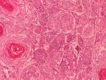 圖6：有些區域腫瘤大多密佈呈囊狀成巢狀，細胞核呈圓形或橢圓形，細胞界限較不明顯，全面性較嗜鹼性，似毛囊基質細胞；局部有中央呈同心板層樣紅色角化物質，周圍由外向內漸近性分化呈扁平細胞包圍。