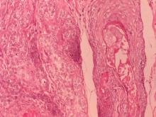 圖7：有些巢狀區域腫瘤團塊，僅周圍細胞較嗜鹼性，似毛囊基質；有些細胞較嗜伊紅性，細胞質較淡染，排列較稀鬆，似毛囊鞘壁細胞；有些區域由外而內漸近性分化呈扁平細胞，細胞界限明顯、呈嗜伊紅性，內容物有嗜伊性角化物質及少許細胞核染色淡之幽靈細胞聚集。 