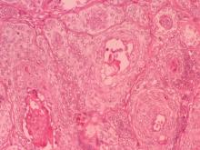 圖8：多數巢狀區域呈嗜伊紅性，細胞質染色淡，排列較稀鬆，細胞界限不甚明顯，核呈圓形或橢圓形，似毛囊鞘壁細胞。