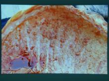 圖1：胸腔與腹腔中皆有大量之血樣液體，並佈滿白色表面粗糙之圓球形小結節。