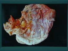 圖2：在腹壁、胃、腸系膜、腸系膜淋巴結，佈滿白色表面粗糙之圓球形小結節。直徑0.1 cm至1.0 cm均有。