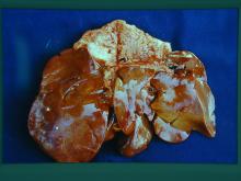 圖3：肝臟、脾臟、膀胱與左腎被膜表面，皆可見白色大小不一表面光滑觸感堅實之團塊。