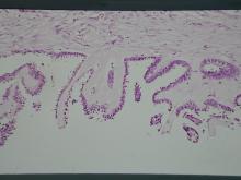 圖4：腫瘤團塊，低倍下內為乳突狀似腺管樣結構內含粉紅色均質物，外有結締組織包被。腫瘤細胞之細胞核大，形狀為圓到卵圓形，核質比大於一，有絲分裂相當明顯。