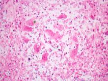 圖3：低倍下腫瘤組織中具有大量巨大細胞。H&E，100×