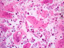 圖4：高倍下可見巨大細胞似蝕骨細胞，核的數目2-20個以上不等。H&E 400×