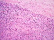 圖2：低倍下腫瘤與正常組織界線清楚並夾雜大量纖維結締組織。H&E， 40×