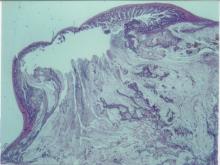 圖1：黏液性腸腺癌低倍組織變化。腸管腺乳突樣增生，有的為囊包狀乳突樣增生。