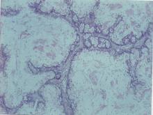 圖2：腸癌的黏液性囊包狀乳突樣增生(mucinous cystic papillary proliferation)