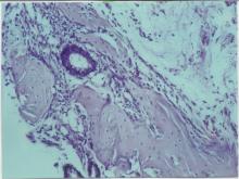 圖4：腫瘤內的類骨質異化，骨組織外圍可見有許多蝕骨細胞。