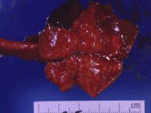 圖1：肺臟可見多發局部性黃白色圓形突起結節，大小約2～4 mm，並深入實質。