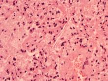 圖2：肺之局部肉芽腫病灶中可見以單核球及巨大細胞為主之炎症細胞浸潤，另可見膽固醇裂隙。