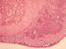 圖3.：淋巴結低倍下可見多發局部肉芽腫，淋巴球減少流失。