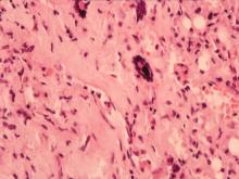 圖4：淋巴結於高倍下可見大量吞噬球及巨大細胞浸潤於壞死灶，內含黴菌菌體。