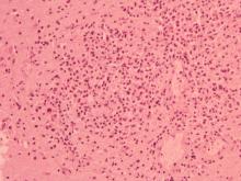 圖5：腦之局部肉芽腫病灶。