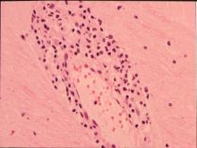 圖6：腦之圍管現象。
