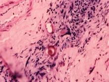 圖7：淋巴結切片經抗酸性染色可見紅色之黴菌菌體。