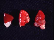 圖3：心臟呈心包炎(左邊為正常心臟)。