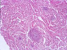 圖4：心臟局部壞死灶。