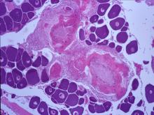 圖5：卵巢實質之肉芽腫。