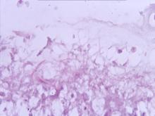 圖7：Ziehl-Neelsen抗酸染色在腹腔接種腸繫膜脂肪組織，可見弱陽性反應、念珠狀長桿菌。