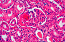 圖5：腎臟以中度瀰漫性絲球體性腎病為主及 局部間質性腎炎。可見約六至七成絲球 體皺縮或鮑氏囊腔充滿滲漏液。（400 ×, H&E）