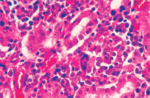 圖6：腎間質中可見典型多核巨大細胞及間質 性腎炎。（400×, H&E）