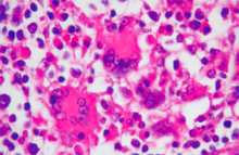 圖7：淋巴結中可見肉芽腫性淋巴腺炎，即所 謂淋巴球大量流失與典型網狀內皮細胞 增生並形成多核巨大細胞。（400×, H&E）