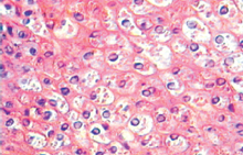圖4：上皮細胞汽球樣變性，細胞質內可見嗜 酸性病毒包涵體。細胞核中央淡染空泡 化。
