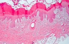 圖3：病變沿著表皮分布，主要發生在表皮層 外側且侷限於表皮層。